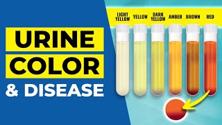 Urine Color Disease Warning!