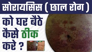 सोरायसिस ( छाल रोग ) को घर बैठे कैसे ठीक करे ? | Psoriasis Lifestyle Management | Dr. Health