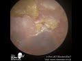 1 242 very difficult ear wax removal in patient with down s syndrome