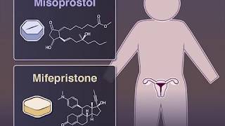 Managing Miscarriage | NEJM