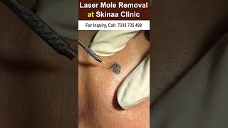 Laser mole removal at skinaaclinic #moleremoval #moleremovalskinaa #viral #shorts  #skinaa_clinic