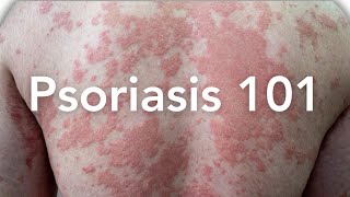 EVERYTHING to Know About Psoriasis | Dermatologist Explains