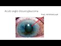 Anterior Chamber Causes of Red Eye