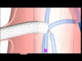 aneurisma da aorta toraco abdominal reparo com endoprótese fenestrada