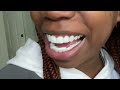 TruSmile Veneers (Review) They’re Finally Here!!! PT2