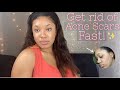 HOW TO PREVENT & GET RID OF HYPERPIGMENTATION FOR GOOD! | Natural remedies & products to fade scars