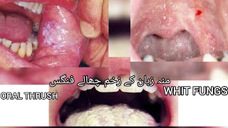 منہ اور زبان کے زخم/چھالے/فنگس  ORAL THRUSH / WHIT FUNGS