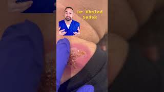 Infected abscess explained #skincare dr khaled sadek