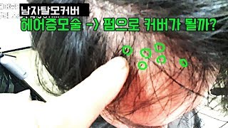 남자탈모커버 방법중에서 헤어증모술한 머리를 펌으로 다시 커버가 될까?