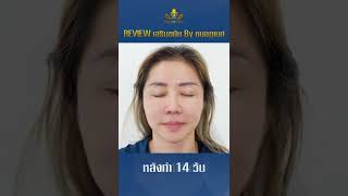 รีวิวเสริมขมับ ครบ 14 วัน เอลิแกนซ์คลินิก | Temporal Augmentation - Dr. Phubeth Jundee