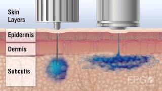 Needle vs InsuJet™ Nozzle injection