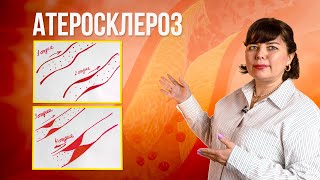 Атеросклероз. Симптомы, методы профилактики и лечения