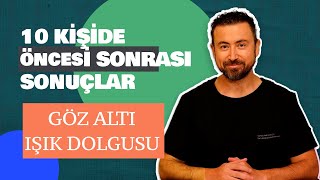 Gözaltı Işık Dolgusu: 10 Hastada Öncesi ve Sonrası Değerlendirme