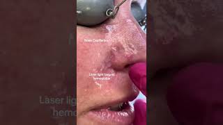 Nose Capillaries #shorts #shortvideo