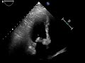 A case of Complete Atrioventricular Block Secondary to Tertiary Hyperparathyroidism