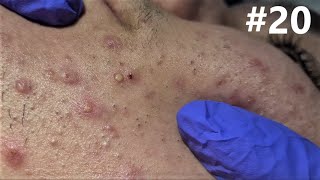 BLACKHEADS EXTRACTIONS on Happy #20