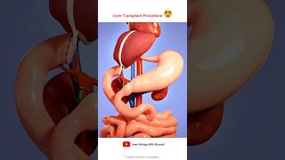 Liver transplant Procedure Animation Video