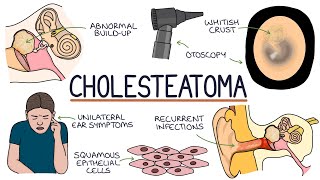 Understanding Cholesteatomas