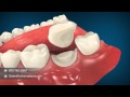 Crown Lengthening Animation | Dental Animation