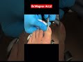 EXTRACTION OF A WICKED INGROWN TOENAIL😬#shorts