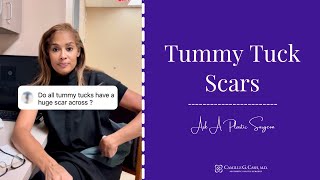 Scarring After a Tummy Tuck I Dr. Camille Cash in Houston