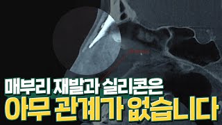 매부리 재발을 막기 위해 실리콘을 넣었다고요? 저는 이해할 수 없습니다