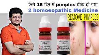 कैसे 15 दिन में pimples ठीक हो गया दो होम्योपैथिक दवा से ? Best Homeopathic medicine | My experience