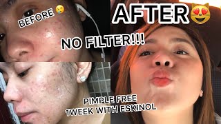 PAANO NAWALA ANG PIMPLES KO IN JUST 1 WEEK! 😱 (ESKINOL IS LIFE!) 😱❤️