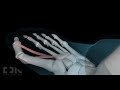 Minimally-Invasive Hallux Valgus Bunion Surgery