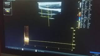 Échographe VINNO 5 avec les sondes