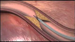 Stroke - Advanced Treatment Options