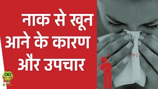 नाक से खून आने के कारण और उपचार | Epistaxis In Hindi | Healthyho