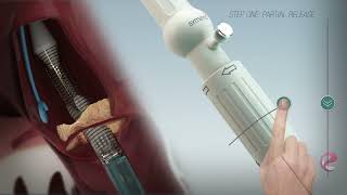 Heart Valve Replacement 3d Animation Video