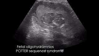 CASE 973 Fetal oligohydramnios POTTER sequence syndrome