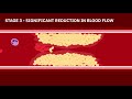 Coronary Artery Disease Animation