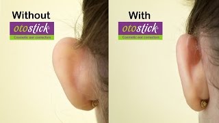 New  Otostick Cosmetic Ear Correctors | A solution for prominent ears