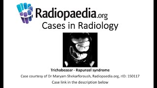 Trichobezoar - Rapunzel syndrome (Radiopaedia.org) Cases in Radiology