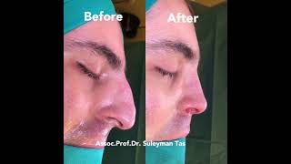 Closed Rhinoplasty Before & After