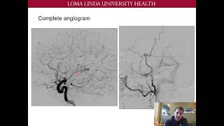 CNS Neurosurgery 100: Treatment of Cranial Arteriovenous Fistulas