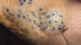 Giant Blackhead Removal