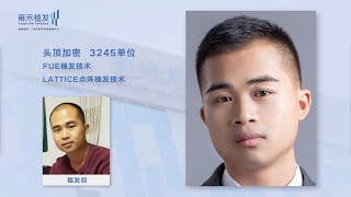 頭頂加密植髮效果好嗎？國內植髮價格是多少！Yonghe hair transplant