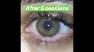 5 Intense laser sessions changes eye color to Green - Irex Laser