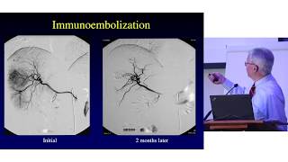 Liver Directed Therapies