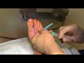 Steroid injection for arthritis big toe