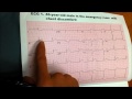 [EKG 1] 46-year-old Male in ER with CHEST DISCOMFORT