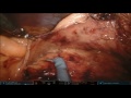 combined laparoscopic robotic approach in complex reoperative colorectal surgery