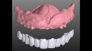 B4D Splint- Copy Denture