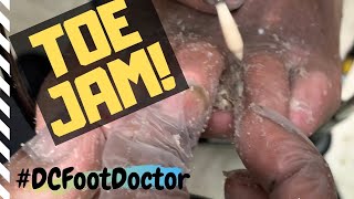 Trimming Fungal Toenails, Corns, Calluses, and Toe Jam: Problems of an At Risk Diabetic