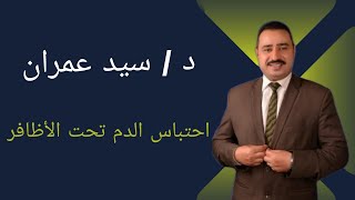 احتباس الدم تحت الأظافر