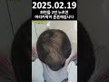 수술없이 탈모관리하는 저만의 경험 노하우 올해안으로 모두 공개할 예정입니다 ep. 115 2025.02.19